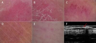 Clinical, dermoscopic, and ultrasonic monitoring of the response to biologic treatment in patients with moderate-to-severe plaque psoriasis